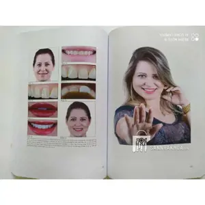 Veneer - Nguyên tắc kế hoạch và kỹ thuật - ảnh sản phẩm thực tế