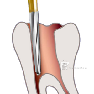 mũi mở tủy endo - ảnh sản phẩm thực tế mũi mở tủy endo - ảnh sản phẩm thực tế