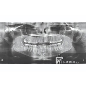 x quang nha khoa nomad pro 2 (máy x-quang cầm tay nomad pro 2) kavo dental technology - ảnh sản phẩm thực tế
