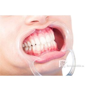 banh môi lip retractors - ảnh sản phẩm thực tế