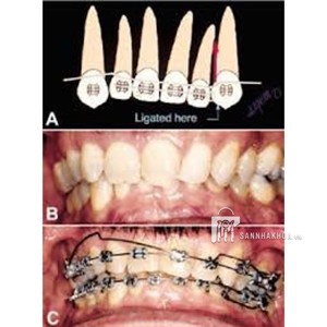 dây cung đánh lún trồi - ảnh sản phẩm thực tế