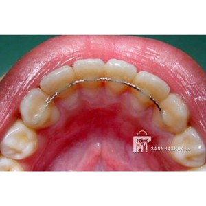 duy trì mặt lưỡi - ảnh sản phẩm thực tế