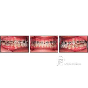 Khí cụ điều trị sai khớp cắn loại II CARRIERE MOTION trong suốt trái/phải (cỡ: 16mm – 27mm) - ảnh sản phẩm thực tế
