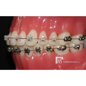 mắc cài răng 7 - ảnh sản phẩm thực tế