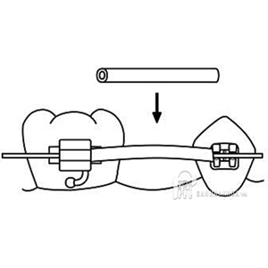 Ống luồn dây cung bảo vệ Nướu/Lợi.046 TISSUE GUARD màu trong/xám - ảnh sản phẩm thực tế