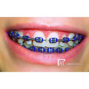 thun buộc mắt cài - ảnh sản phẩm thực tế