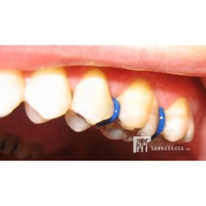 thun tách kẽ màu trắng/xanh separators posterior - ảnh sản phẩm thực tế