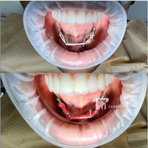 vật liệu làm chuyển khóa implant - ảnh sản phẩm thực tế vật liệu làm chuyển khóa implant - ảnh sản phẩm thực tế