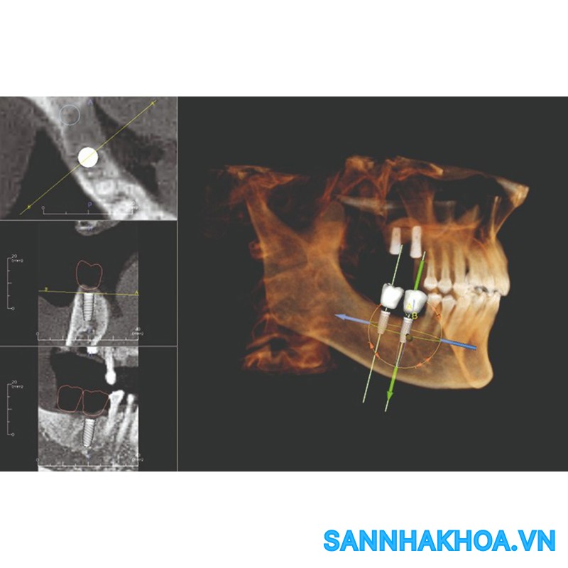 Cbct Kavo Op 3d Vision Mua Máy Chụp Ct Kavo Op 3D Vision Kavo